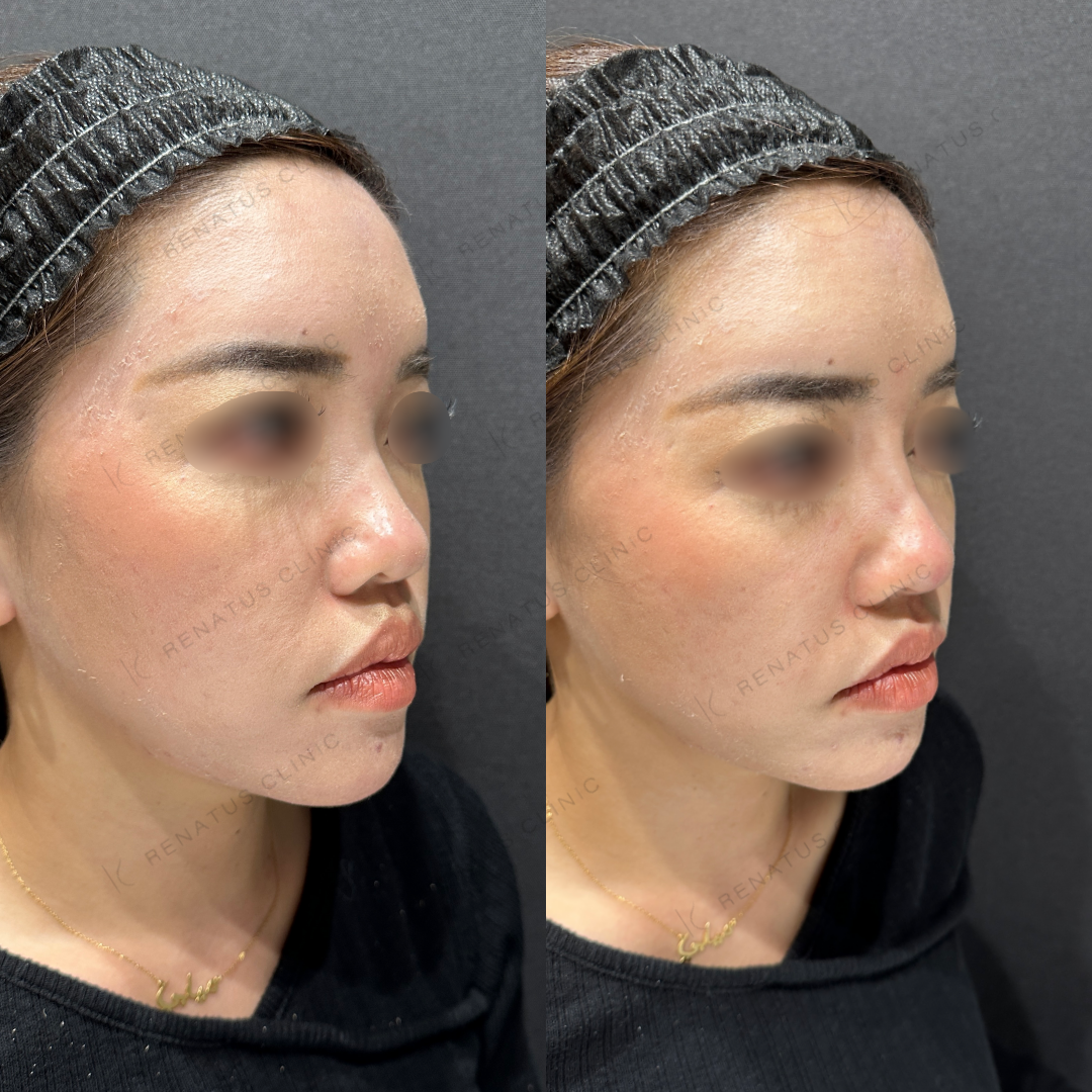 鼻根・鼻筋・鼻中隔ヒアルロン酸ボラックス症例写真