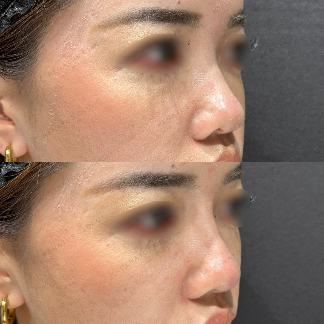 鼻根・鼻筋・鼻中隔ヒアルロン酸ボラックス症例写真