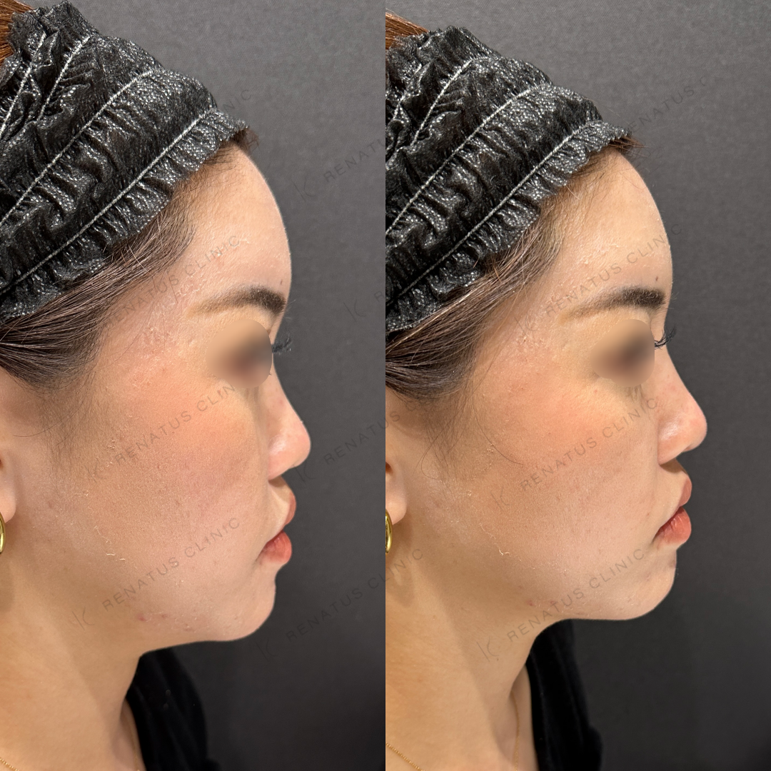 鼻根・鼻筋・鼻中隔ヒアルロン酸ボラックス症例写真