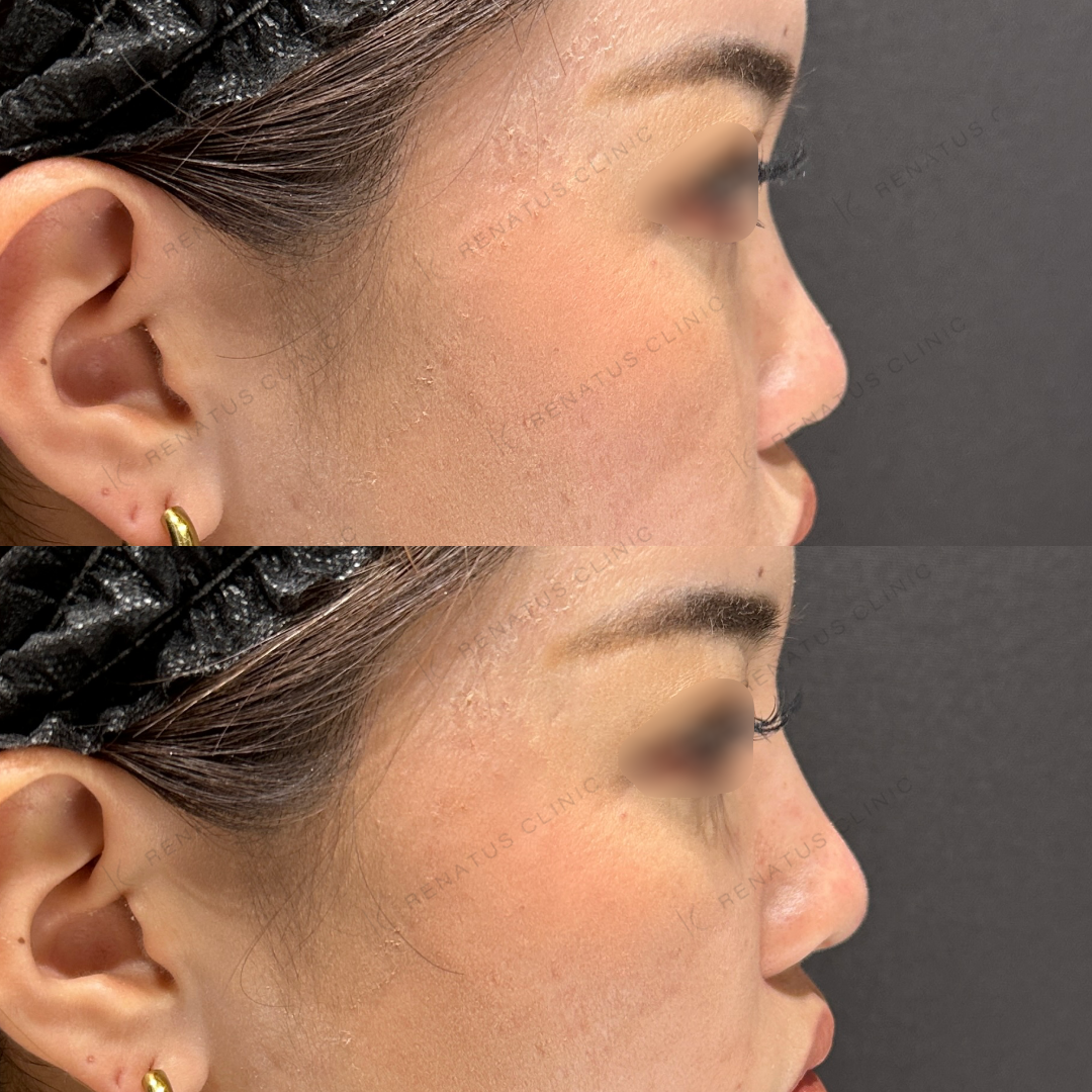 鼻根・鼻筋・鼻中隔ヒアルロン酸ボラックス症例写真