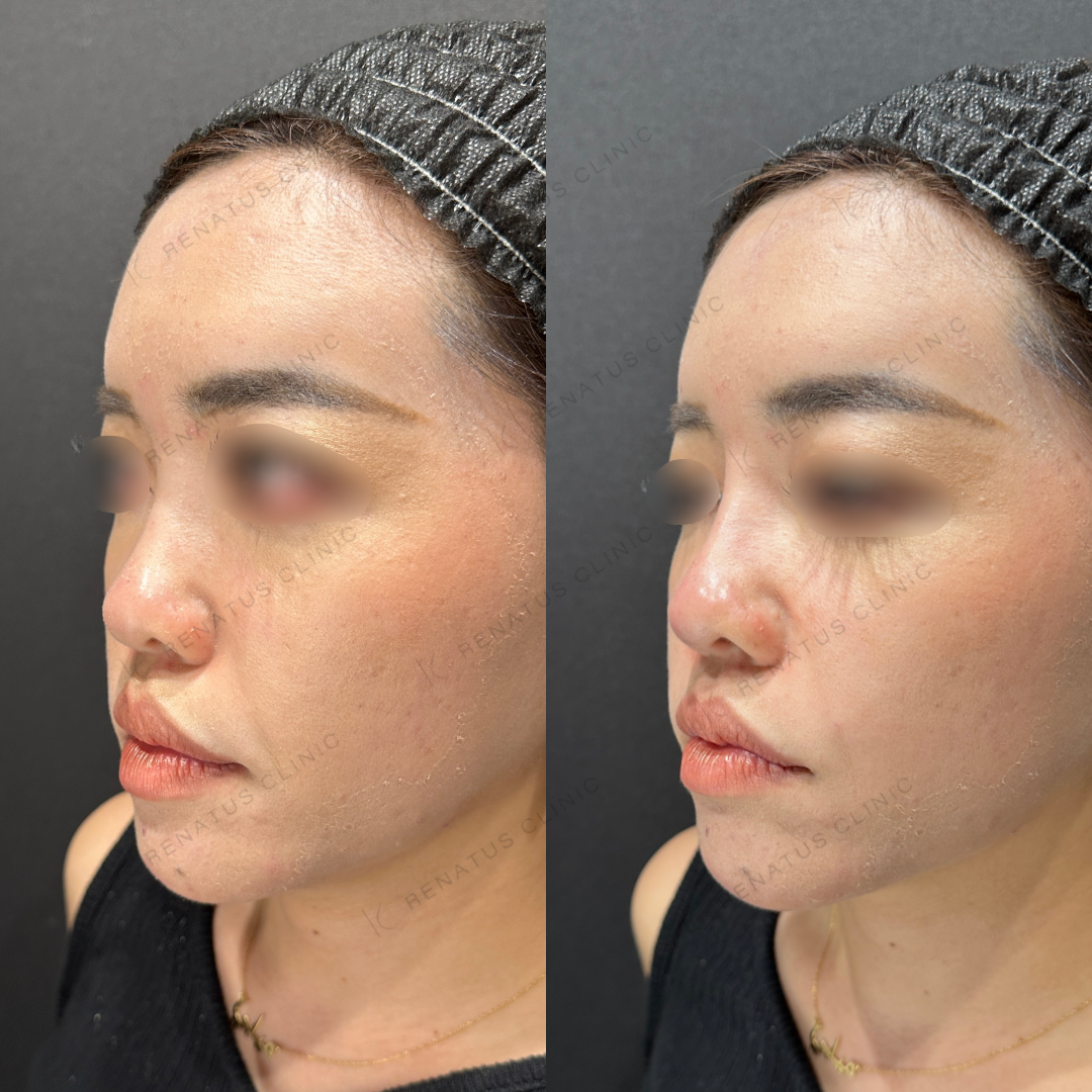 鼻根・鼻筋・鼻中隔ヒアルロン酸ボラックス症例写真