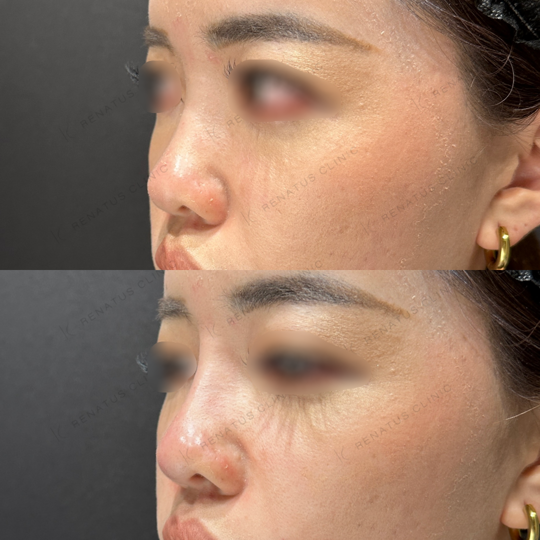 鼻根・鼻筋・鼻中隔ヒアルロン酸ボラックス症例写真
