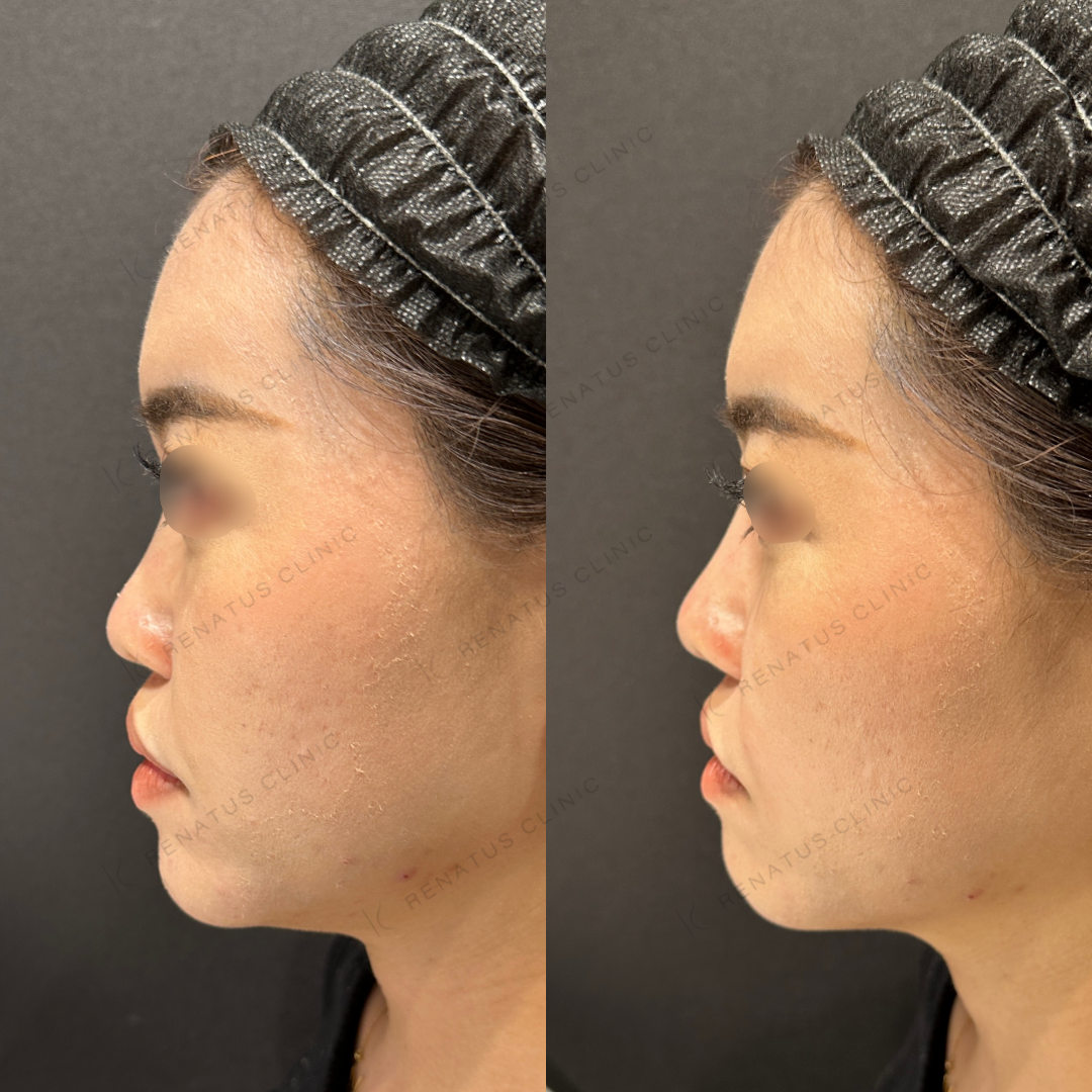 鼻根・鼻筋・鼻中隔ヒアルロン酸ボラックス症例写真