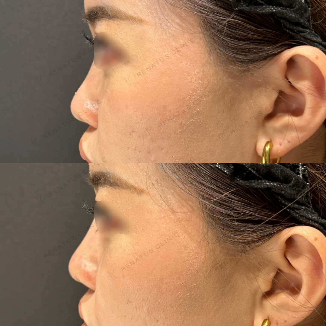 鼻根・鼻筋・鼻中隔ヒアルロン酸ボラックス症例写真