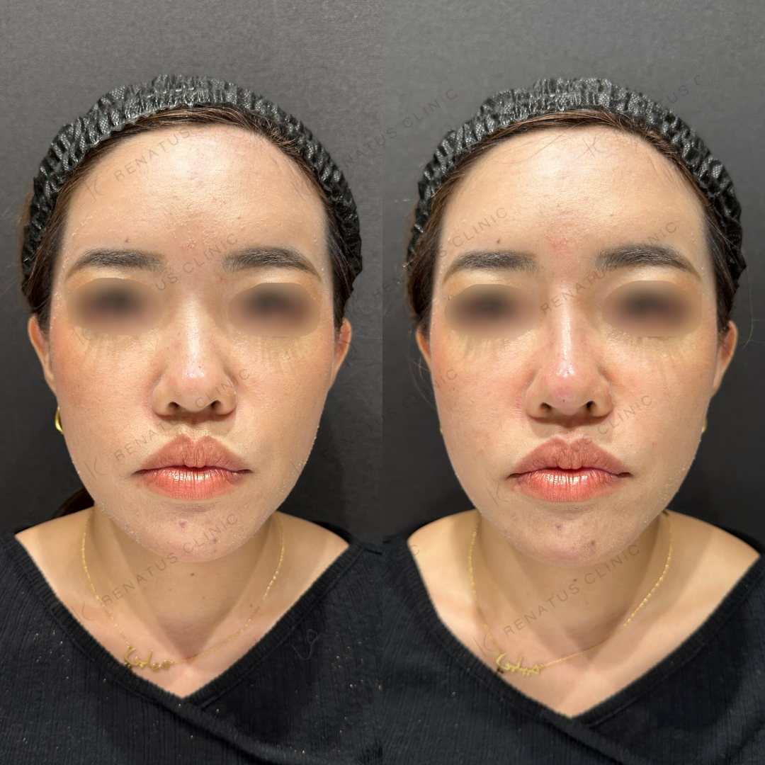 鼻根・鼻筋・鼻中隔ヒアルロン酸ボラックス症例写真