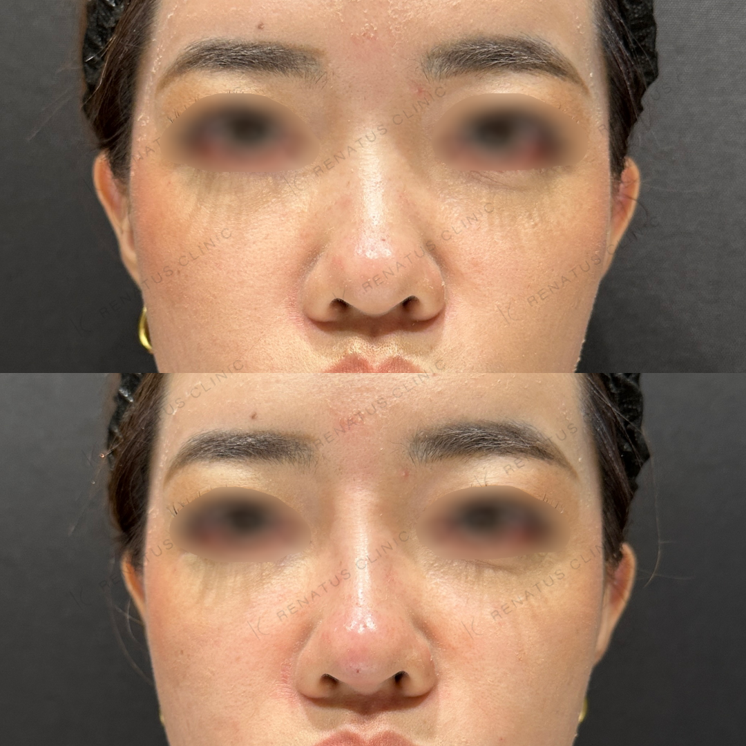 鼻根・鼻筋・鼻中隔ヒアルロン酸ボラックス症例写真