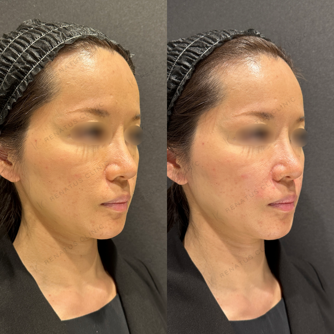 鼻翼基部ヒアルロン酸ボリフト症例写真