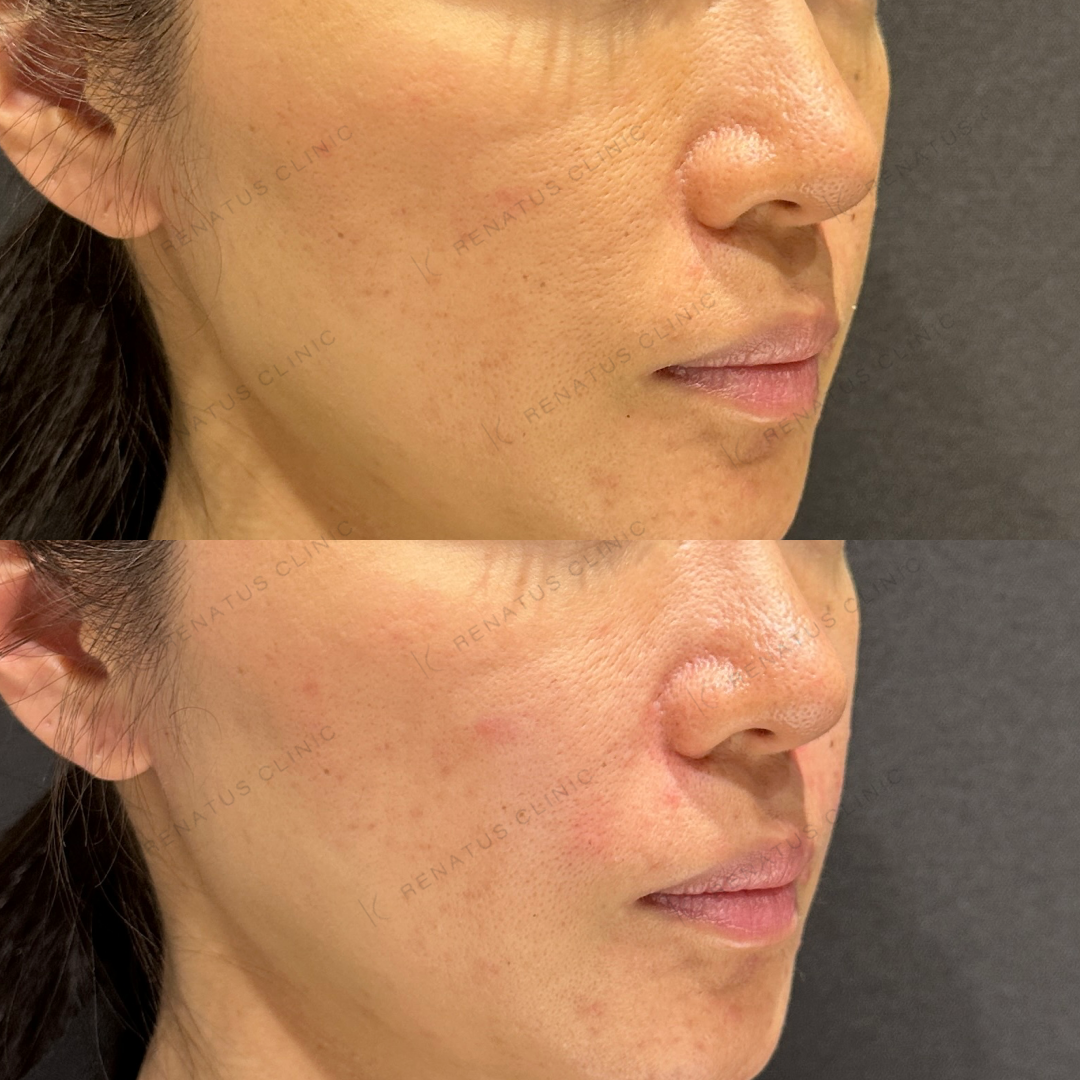 鼻翼基部ヒアルロン酸ボリフト症例写真