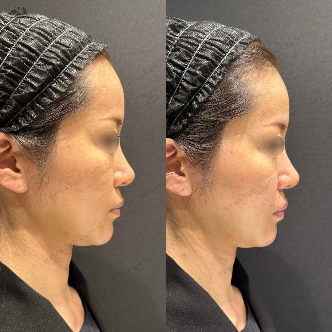 鼻翼基部ヒアルロン酸ボリフト症例写真