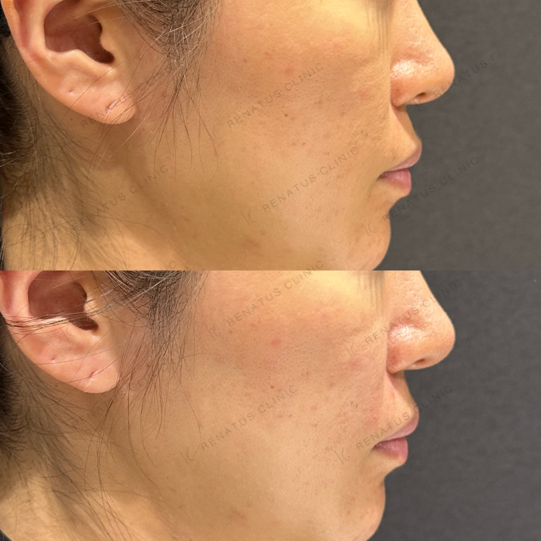 鼻翼基部ヒアルロン酸ボリフト症例写真