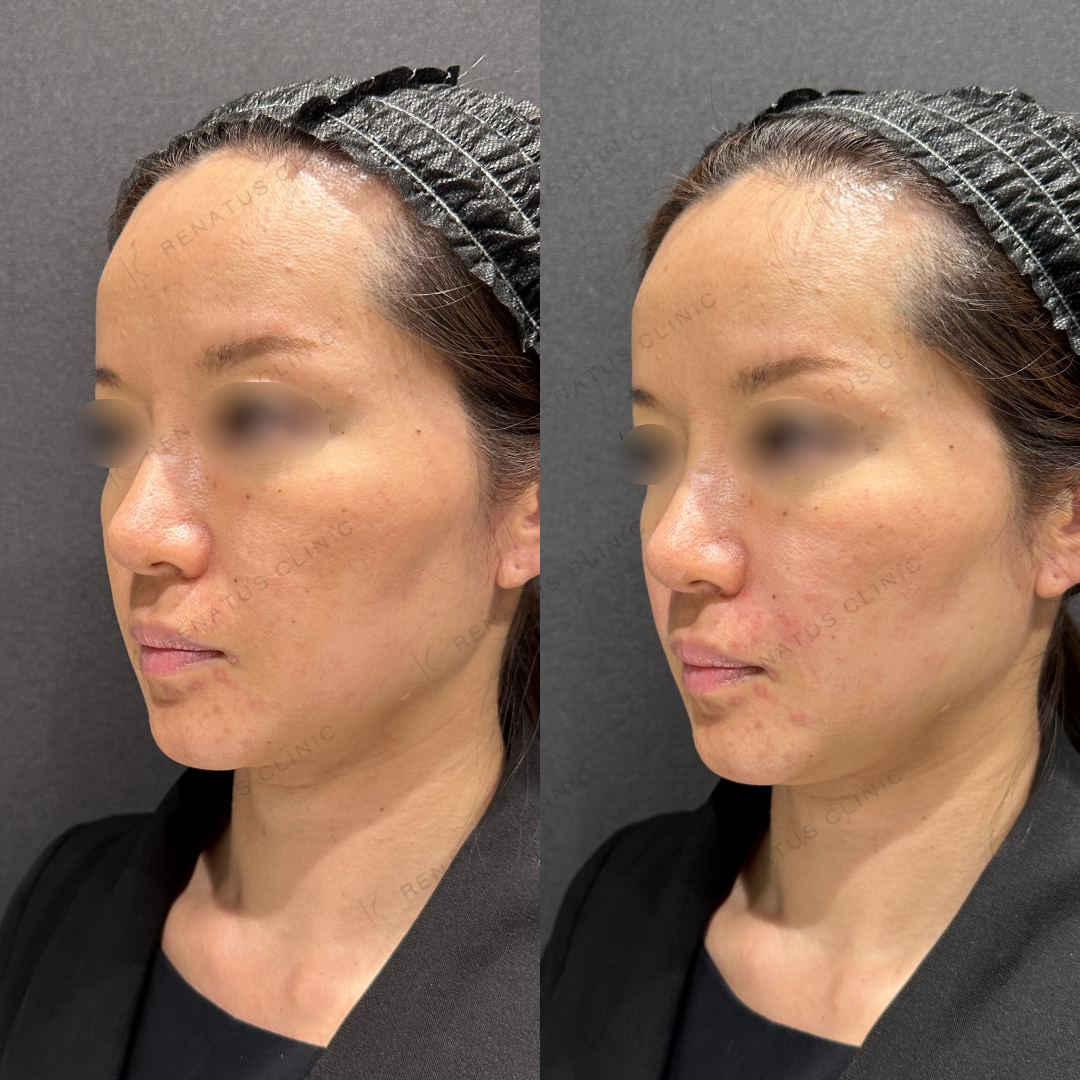 鼻翼基部ヒアルロン酸ボリフト症例写真