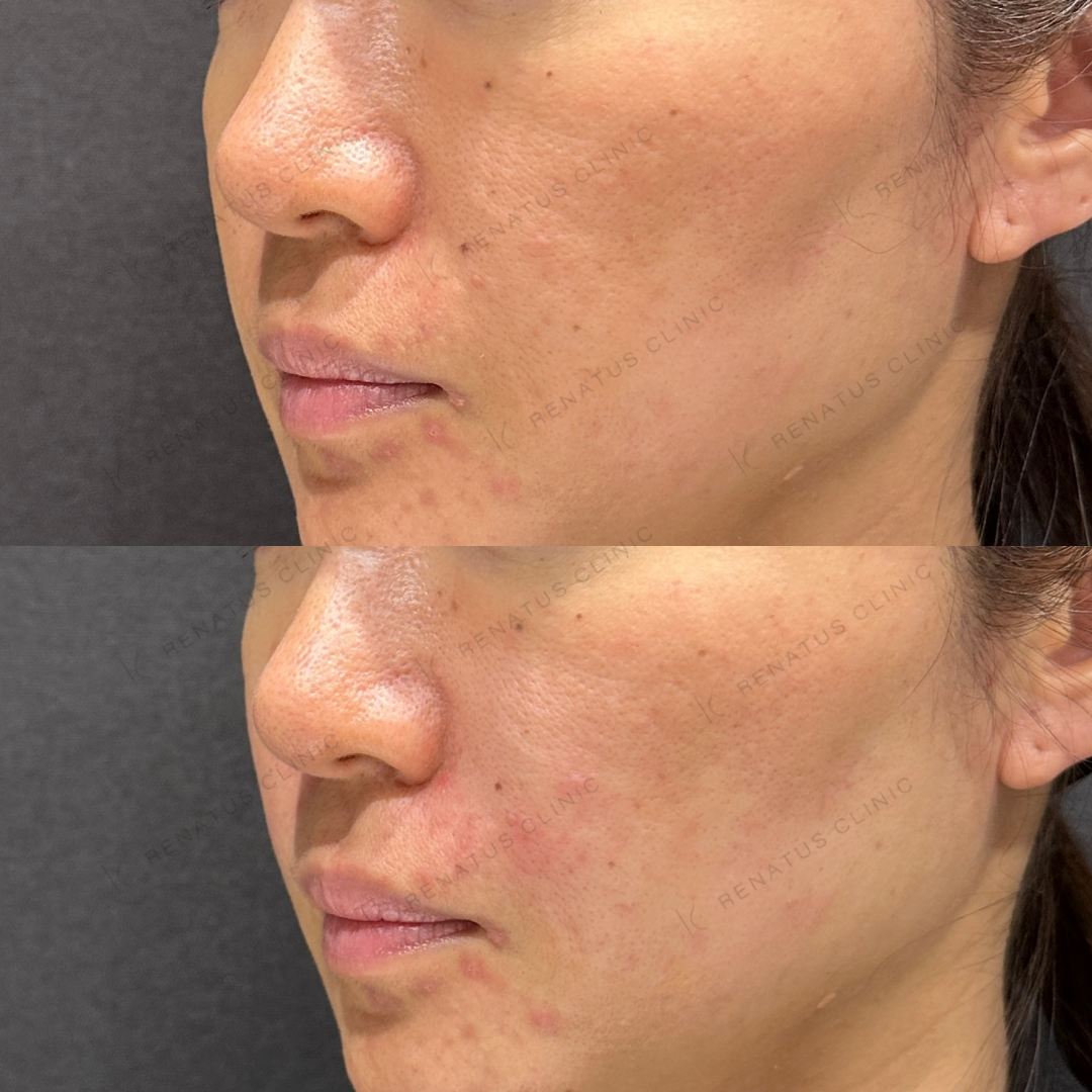 鼻翼基部ヒアルロン酸ボリフト症例写真