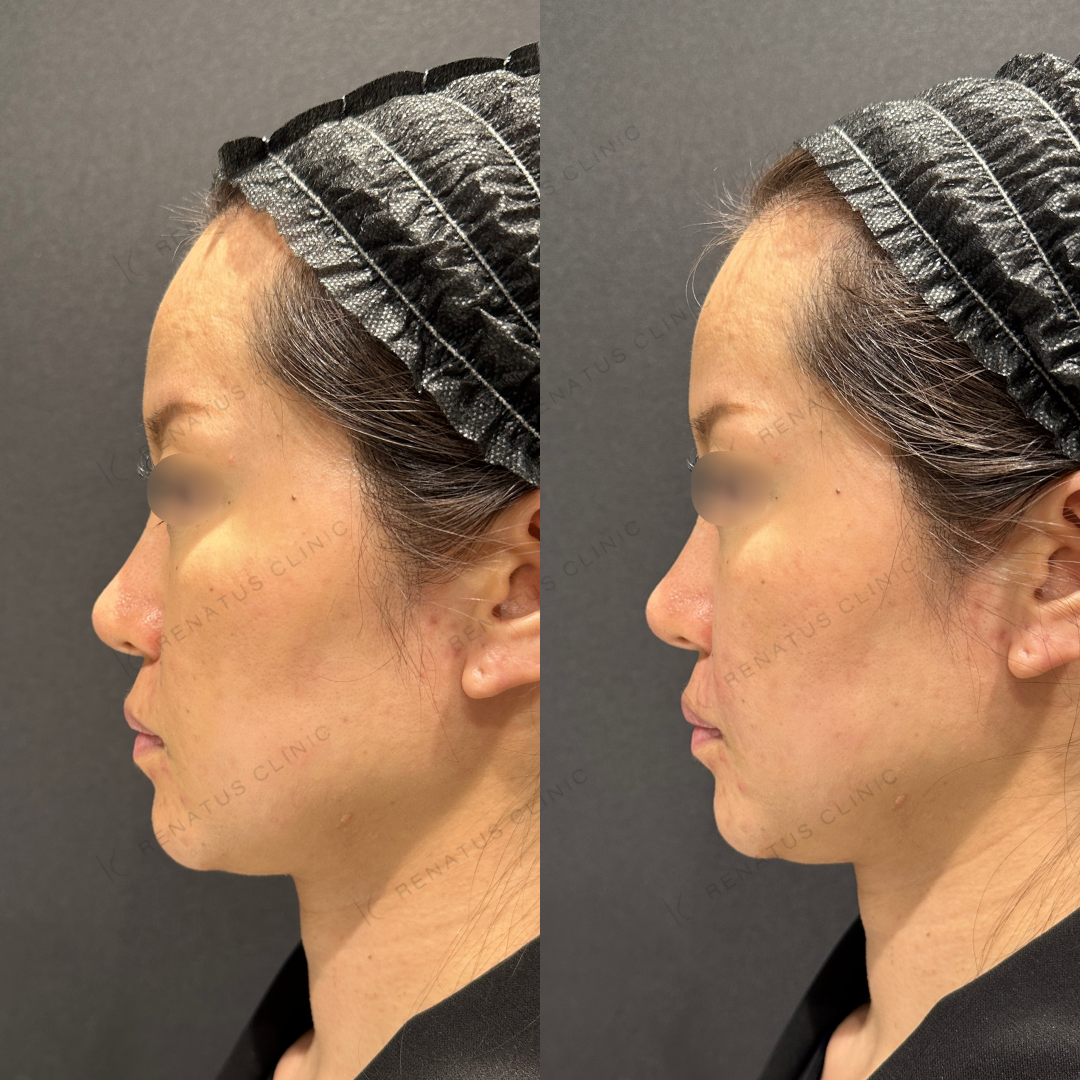 鼻翼基部ヒアルロン酸ボリフト症例写真