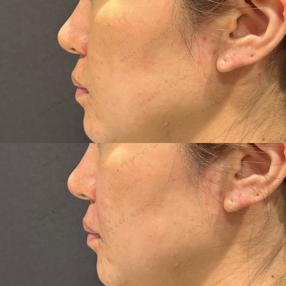 鼻翼基部ヒアルロン酸ボリフト症例写真