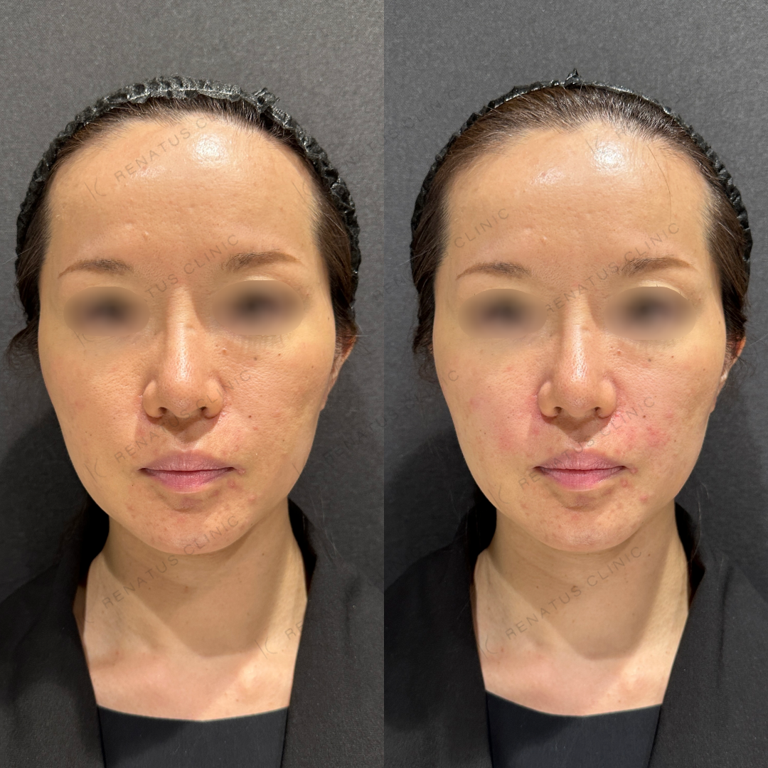 鼻翼基部ヒアルロン酸ボリフト症例写真