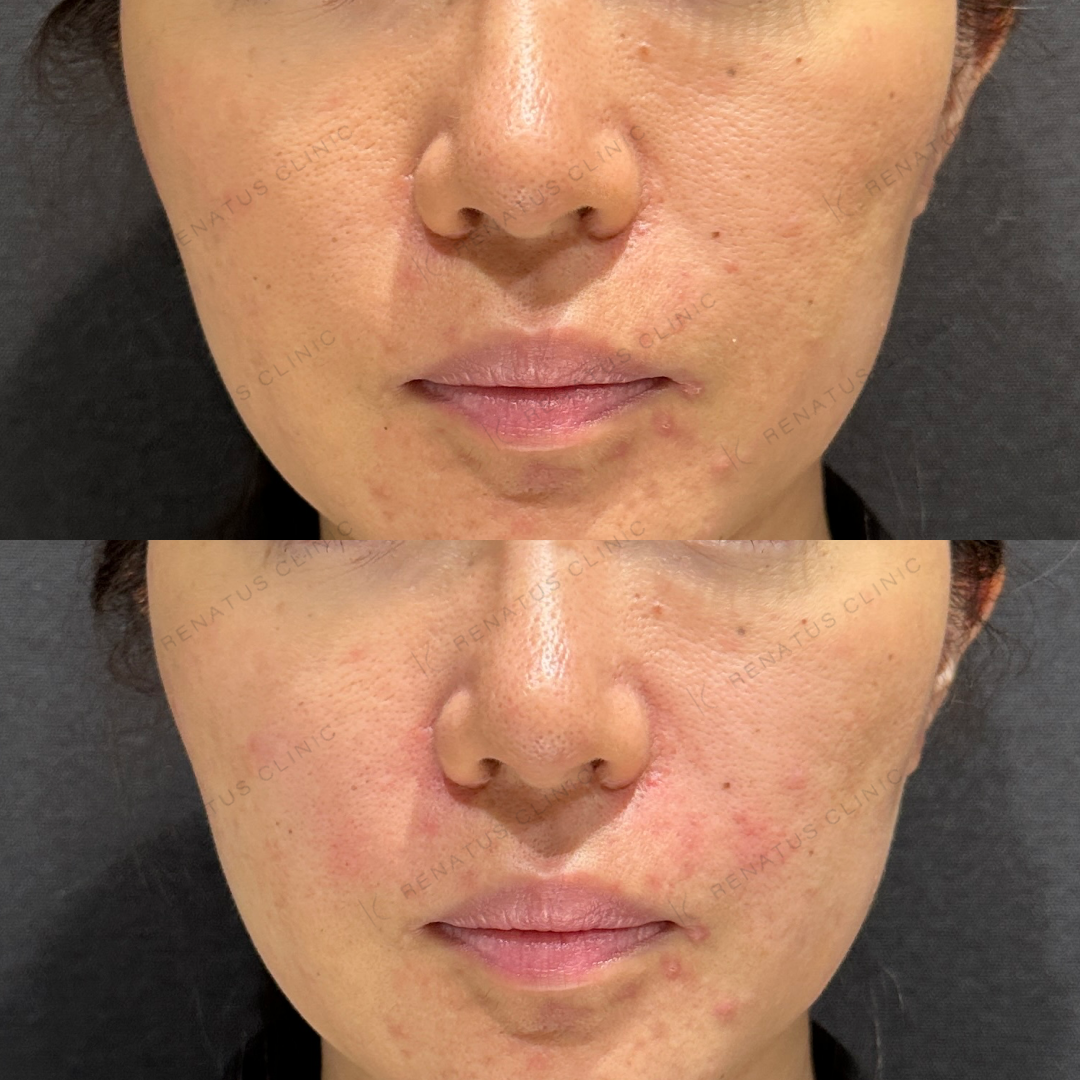 鼻翼基部ヒアルロン酸ボリフト症例写真