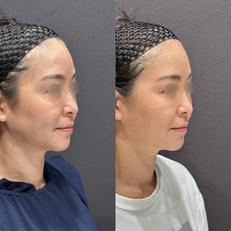 糸リフト症例写真