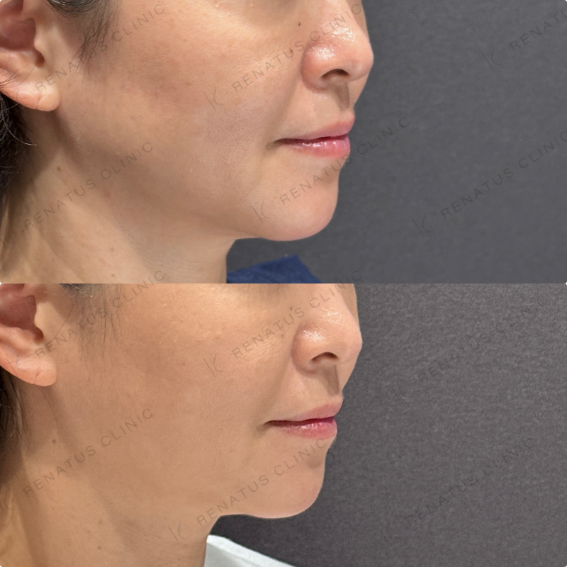 糸リフト症例写真