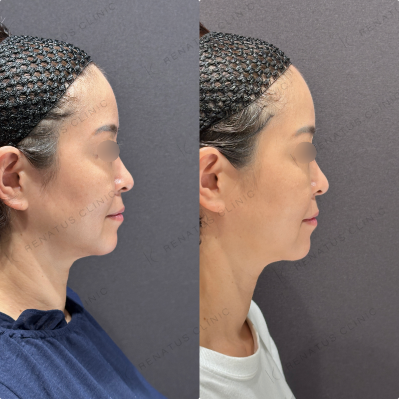 糸リフト症例写真