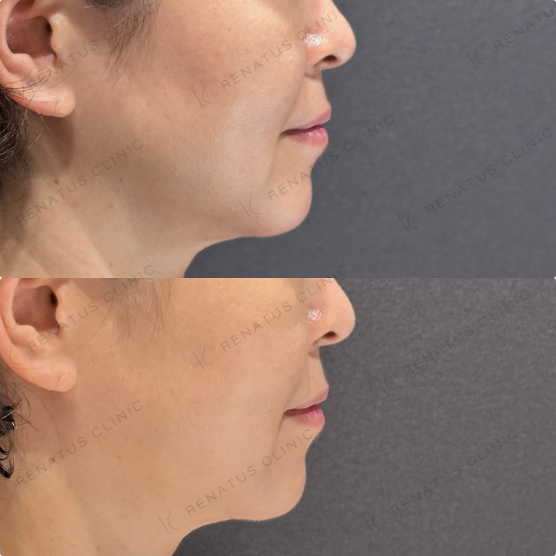 糸リフト症例写真