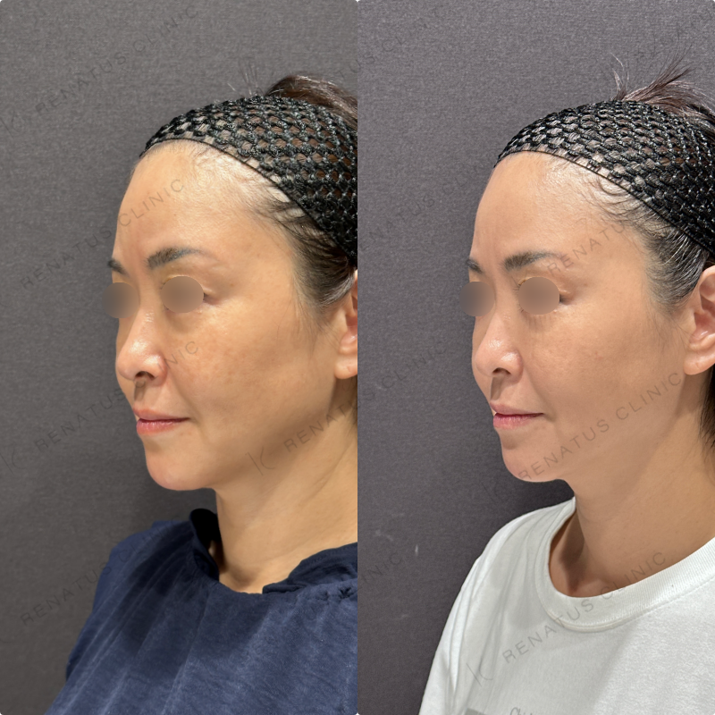 糸リフト症例写真