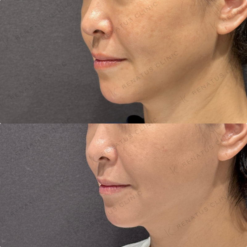 糸リフト症例写真