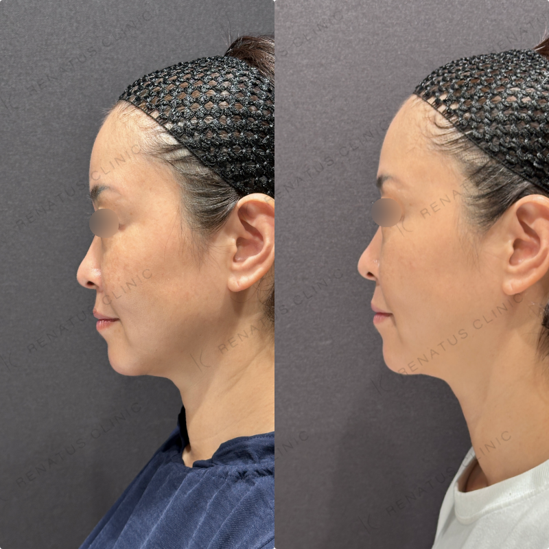 糸リフト症例写真