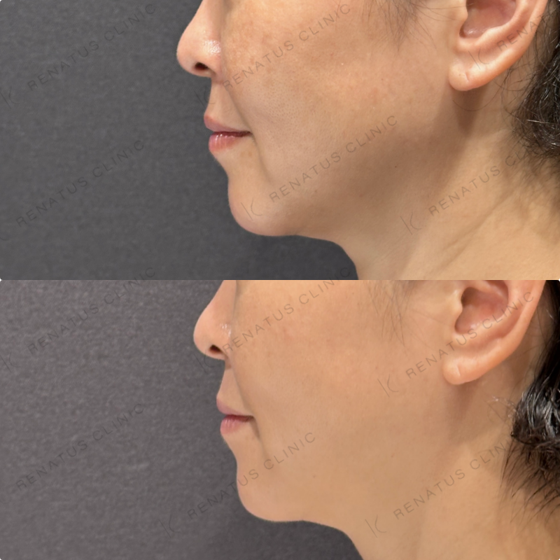 糸リフト症例写真