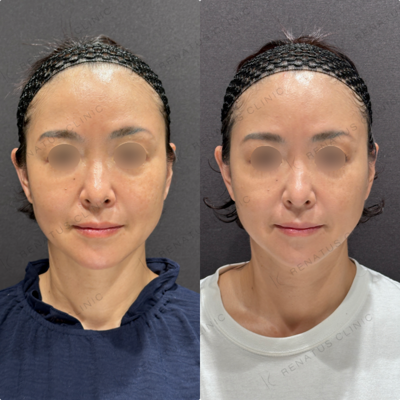 糸リフト症例写真