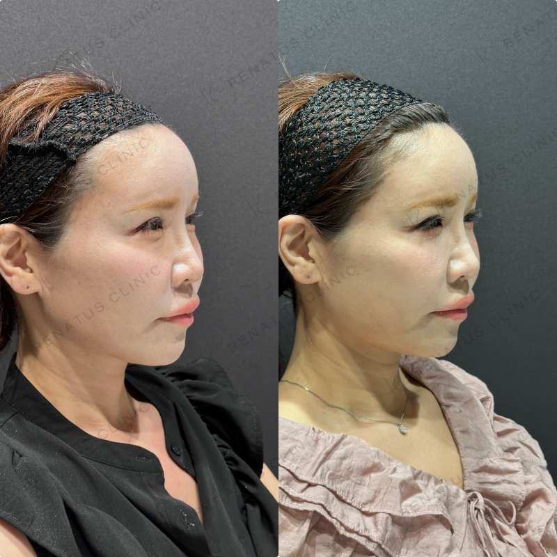 目の下のクマ取り症例写真