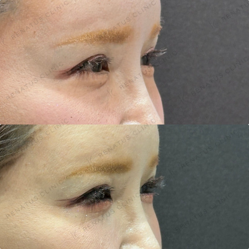 目の下のクマ取り症例写真