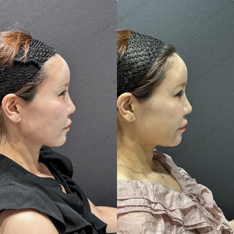 目の下のクマ取り症例写真