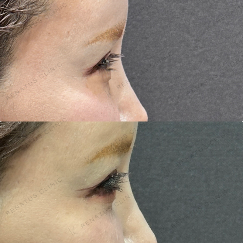 目の下のクマ取り症例写真