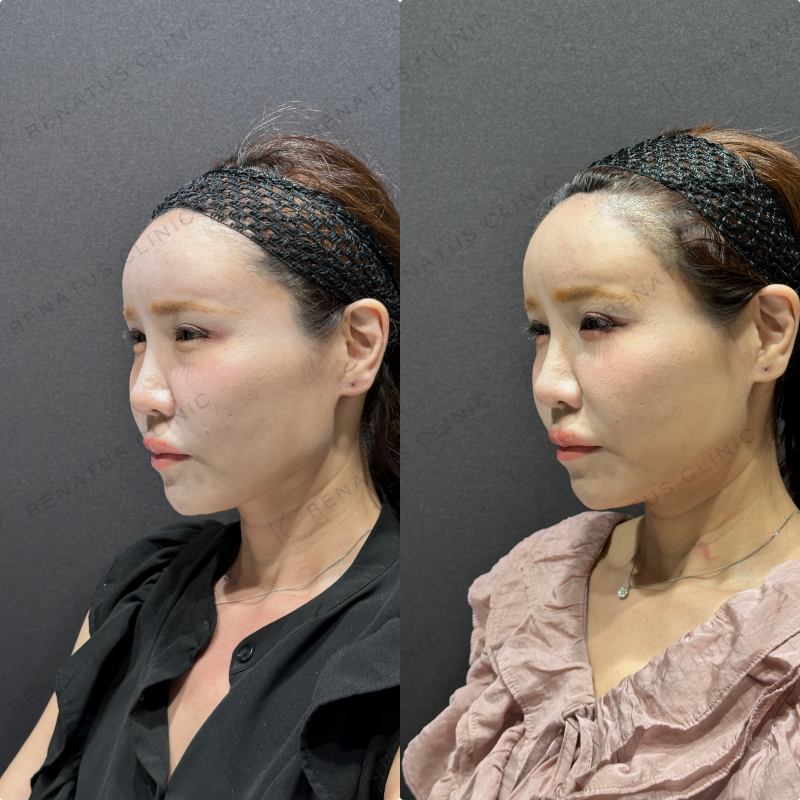 目の下のクマ取り症例写真