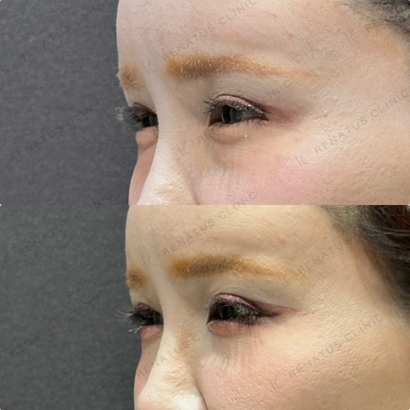 目の下のクマ取り症例写真