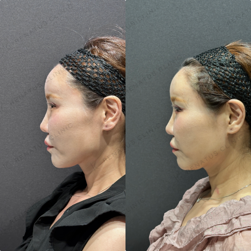 目の下のクマ取り症例写真