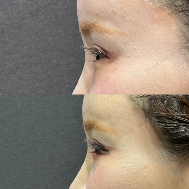 目の下のクマ取り症例写真