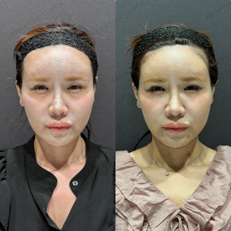 目の下のクマ取り症例写真