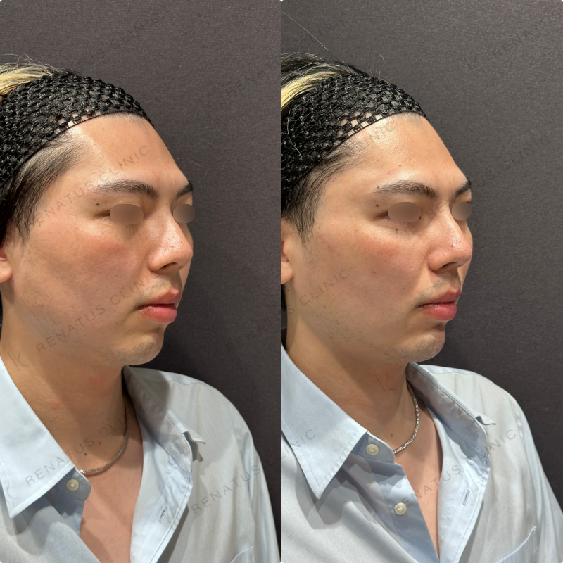 こめかみ・頬・目の下・顎ヒアルロン酸ボリューマ・ボルベラ・ボラックス症例写真