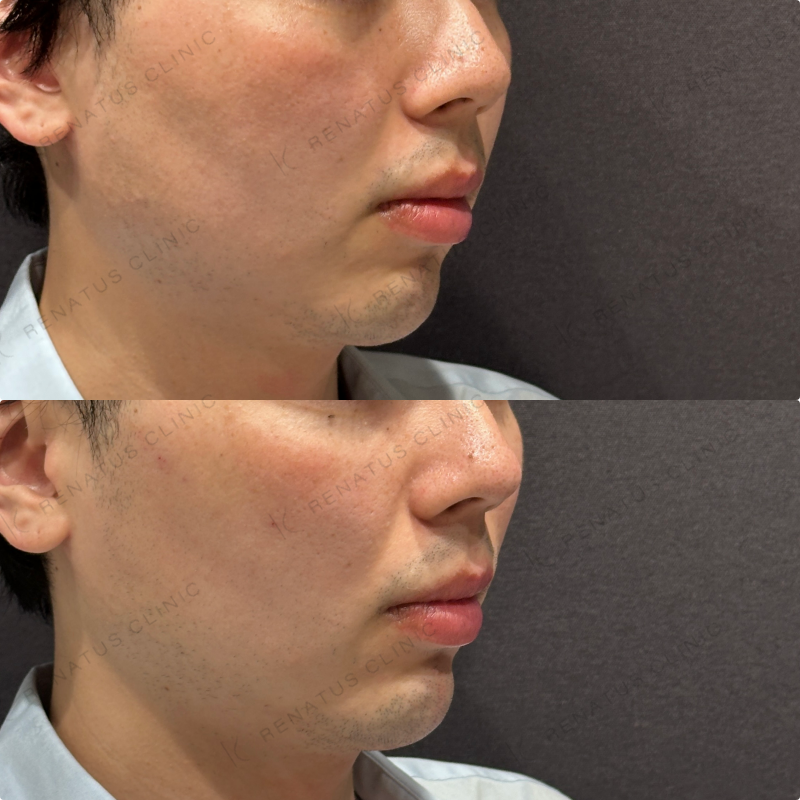 こめかみ・頬・目の下・顎ヒアルロン酸ボリューマ・ボルベラ・ボラックス症例写真