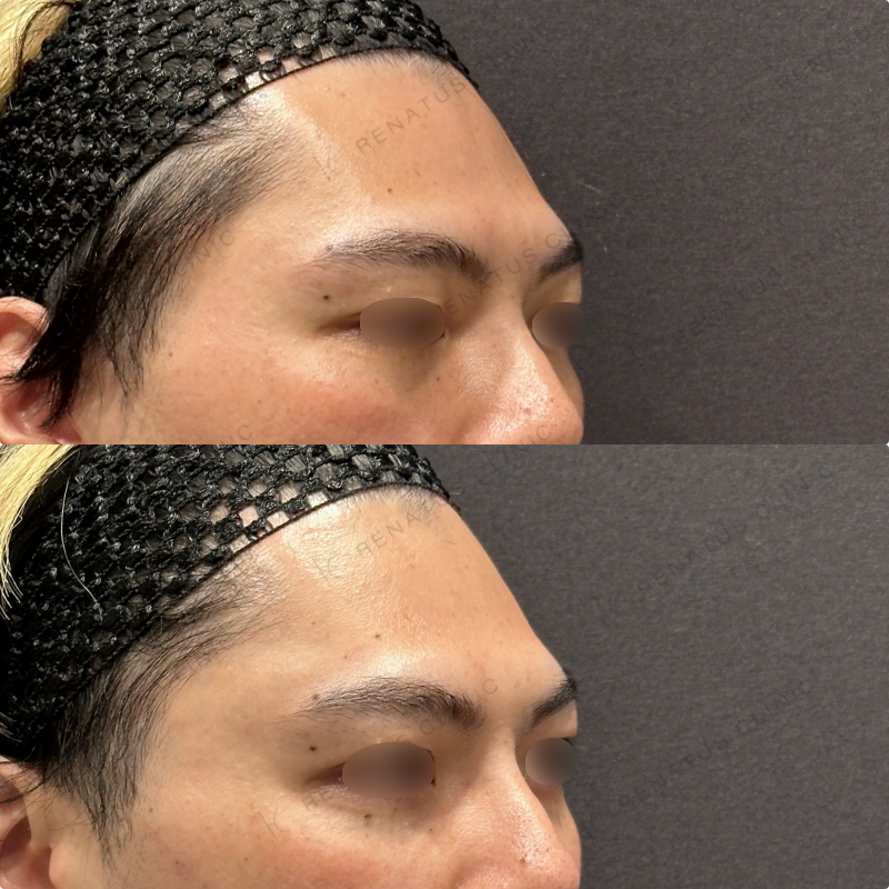 こめかみ・頬・目の下・顎ヒアルロン酸ボリューマ・ボルベラ・ボラックス症例写真