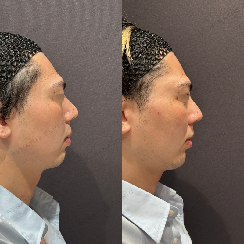 こめかみ・頬・目の下・顎ヒアルロン酸ボリューマ・ボルベラ・ボラックス症例写真