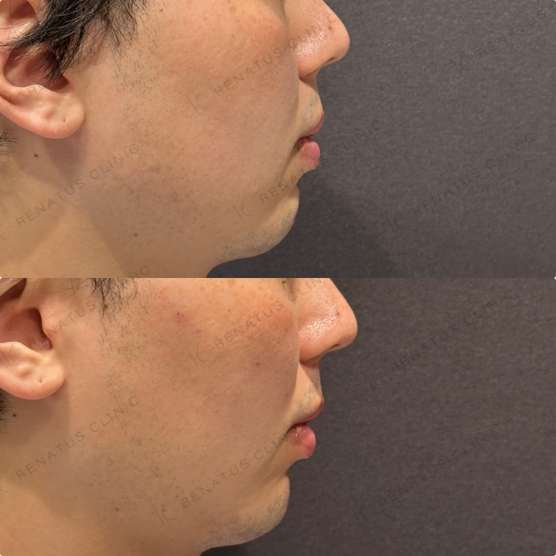 こめかみ・頬・目の下・顎ヒアルロン酸ボリューマ・ボルベラ・ボラックス症例写真