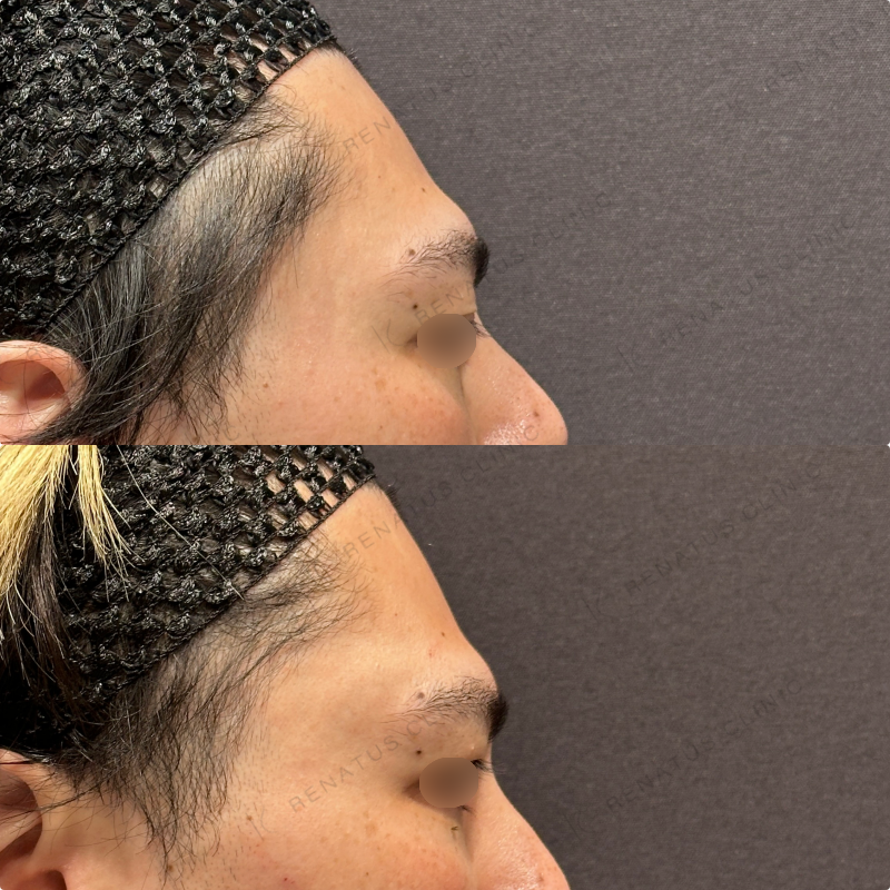 こめかみ・頬・目の下・顎ヒアルロン酸ボリューマ・ボルベラ・ボラックス症例写真