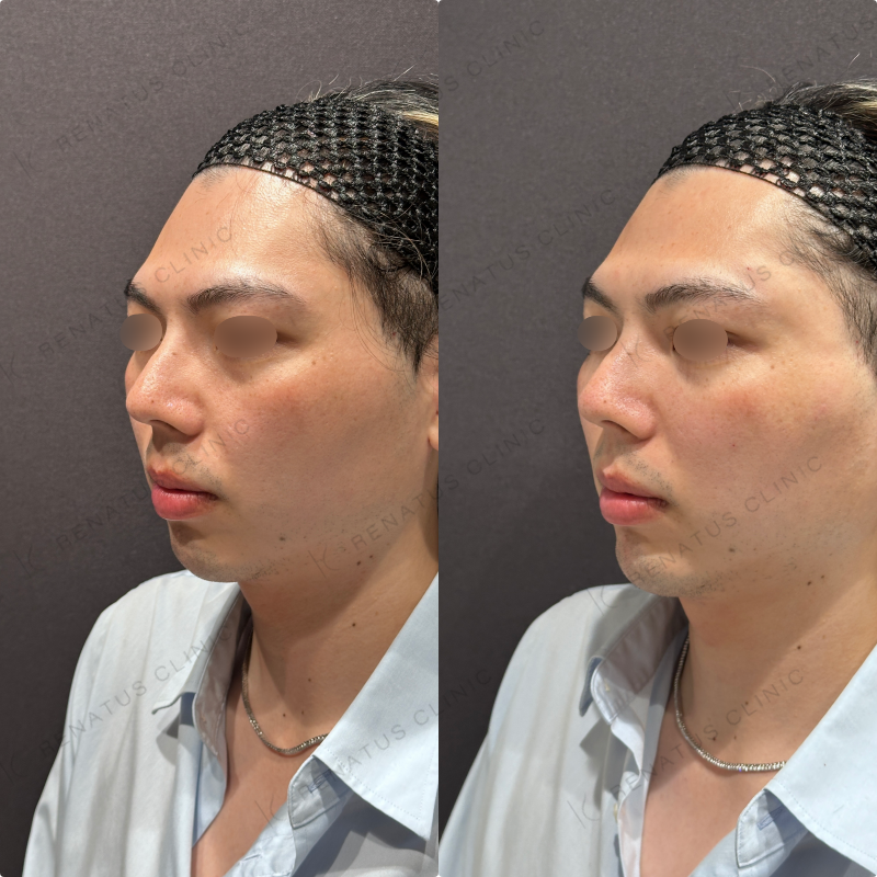 こめかみ・頬・目の下・顎ヒアルロン酸ボリューマ・ボルベラ・ボラックス症例写真