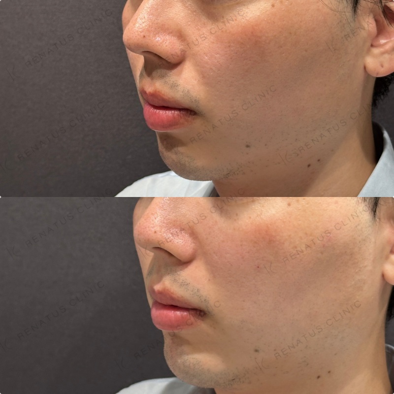 こめかみ・頬・目の下・顎ヒアルロン酸ボリューマ・ボルベラ・ボラックス症例写真