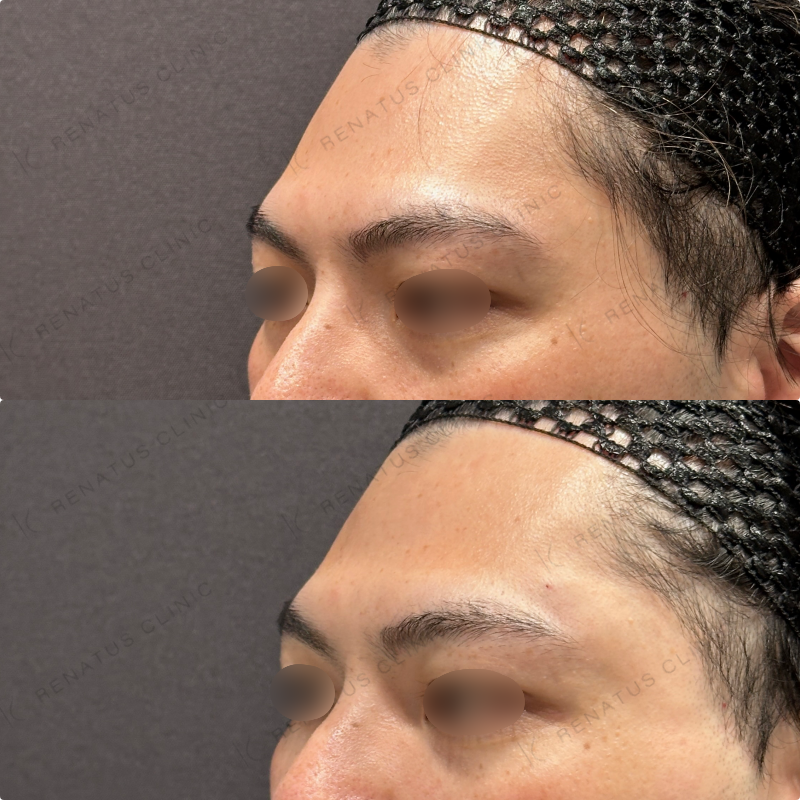 こめかみ・頬・目の下・顎ヒアルロン酸ボリューマ・ボルベラ・ボラックス症例写真