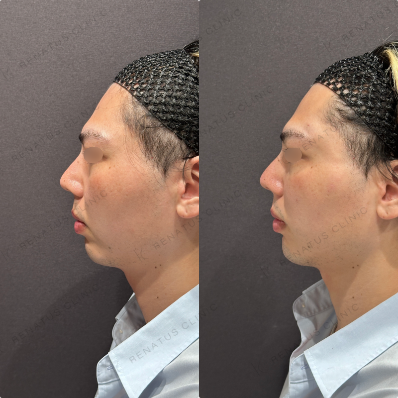 こめかみ・頬・目の下・顎ヒアルロン酸ボリューマ・ボルベラ・ボラックス症例写真