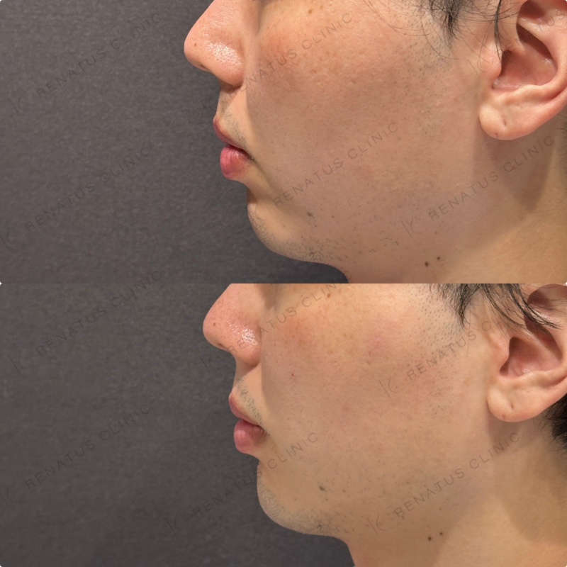 こめかみ・頬・目の下・顎ヒアルロン酸ボリューマ・ボルベラ・ボラックス症例写真