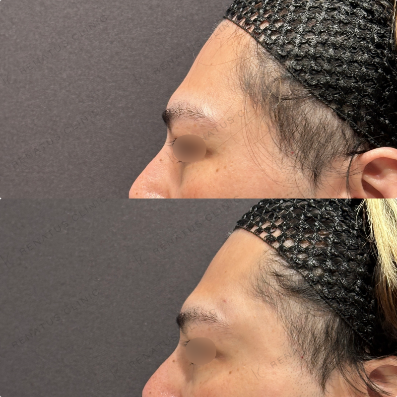 こめかみ・頬・目の下・顎ヒアルロン酸ボリューマ・ボルベラ・ボラックス症例写真